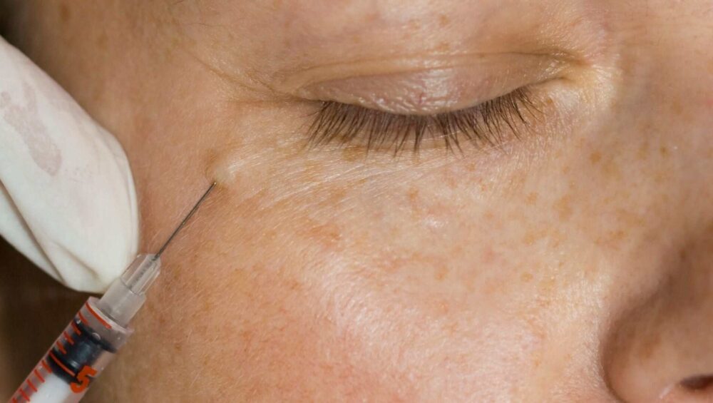 Under eye polynucleotides injections.