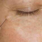 Under eye polynucleotides injections.